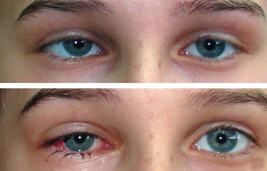 Prima e dopo il trattamento Oculax
